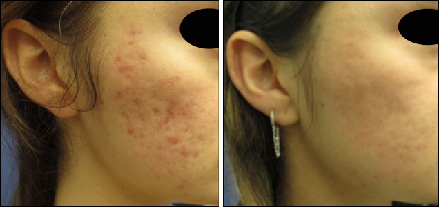 acne_treatment